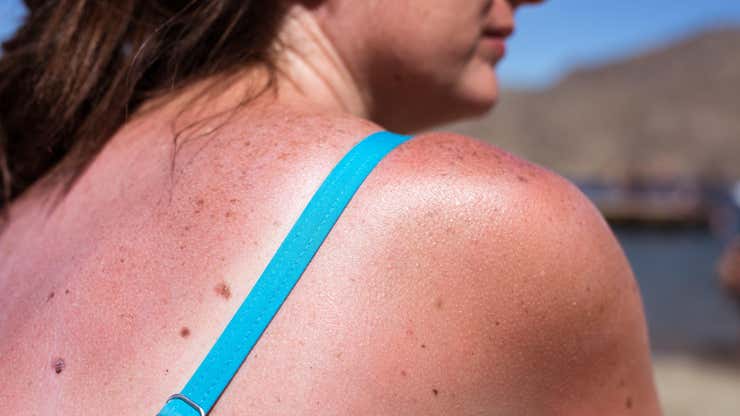 Image for What to Do (and Not Do) When Your Sunburn Starts Peeling