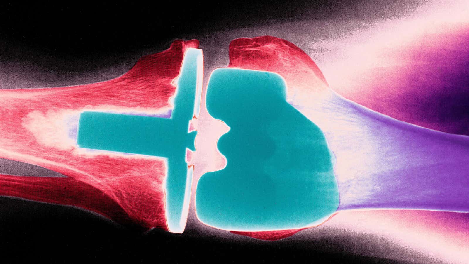How long will it be until someone you know has 3D-printed ‘scaffolding’ in their knee?