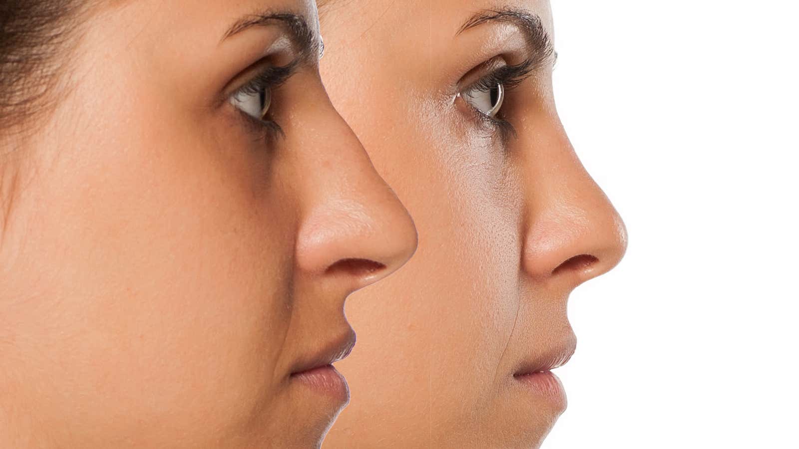 Comparative portrait of a young woman before and after rhinoplasty.