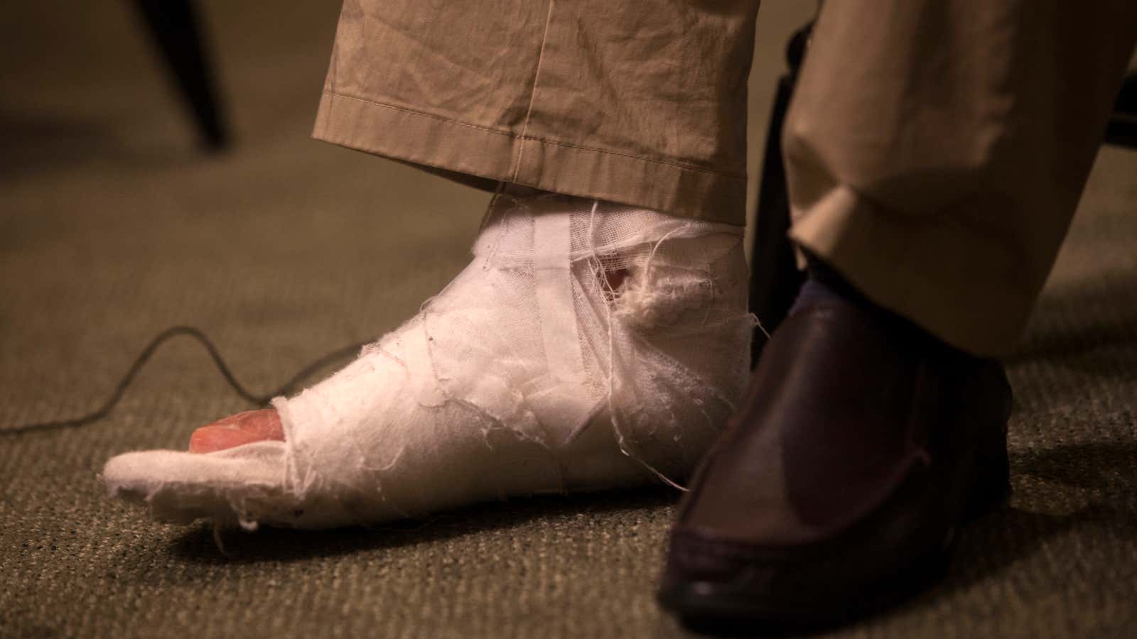 A cast on the right foot of Chen Guangcheng, a blind Chinese dissident and legal advocate who recently sought asylum in the US.