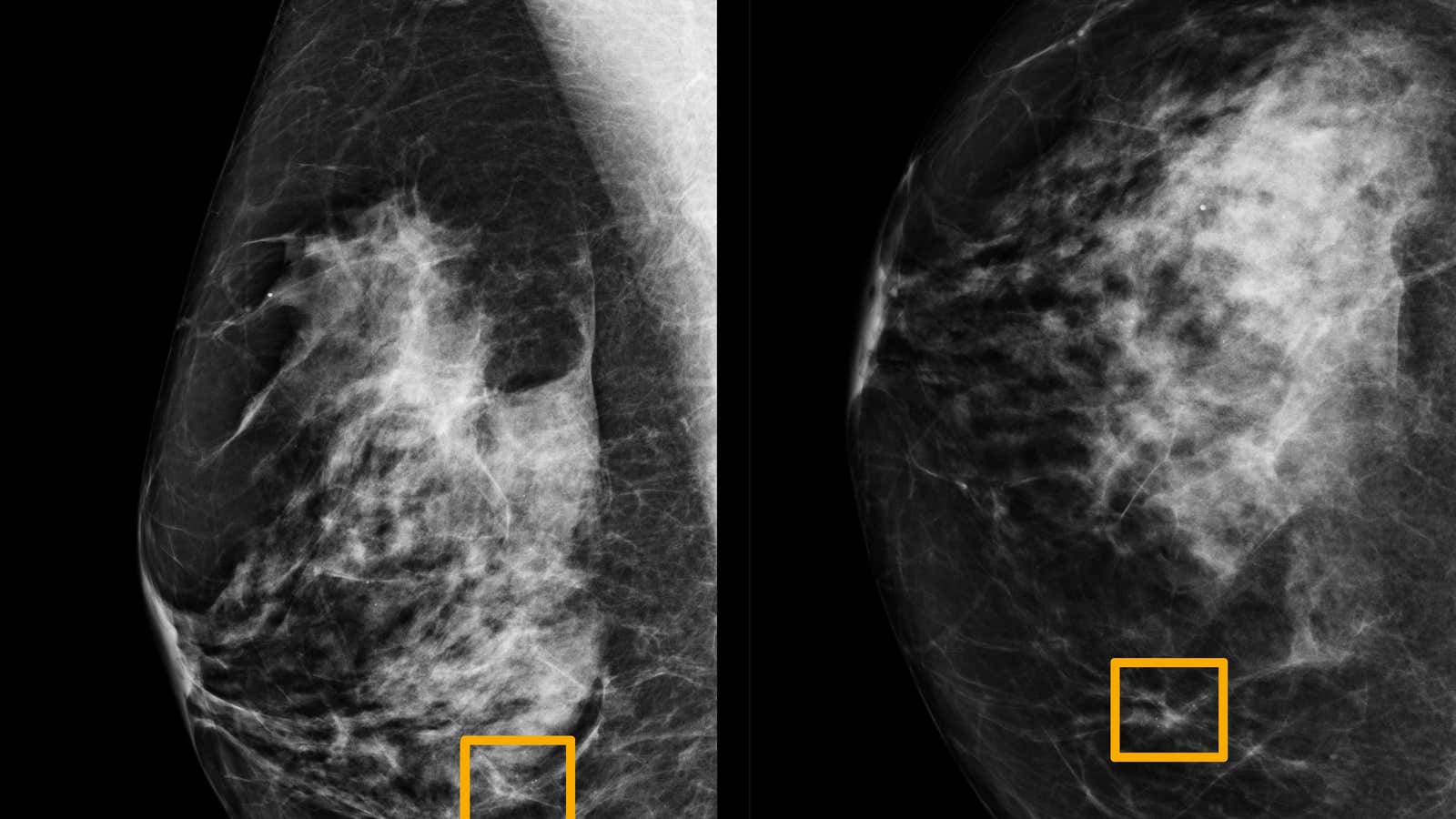Can AI deliver a better mammogram?