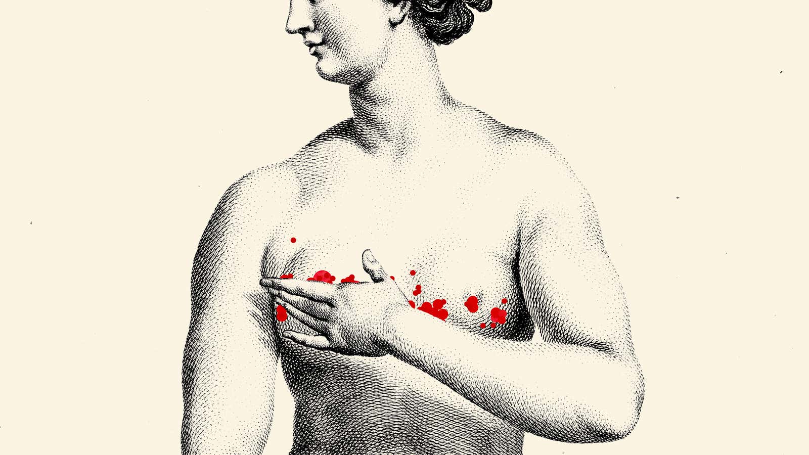 Herpes Drew a Scarlet Letter Across My Breasts