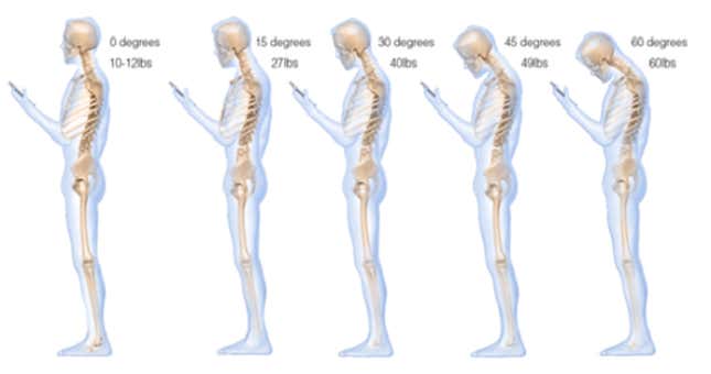Image for article titled My Smartphone Gave Me a Painful Neurological Condition