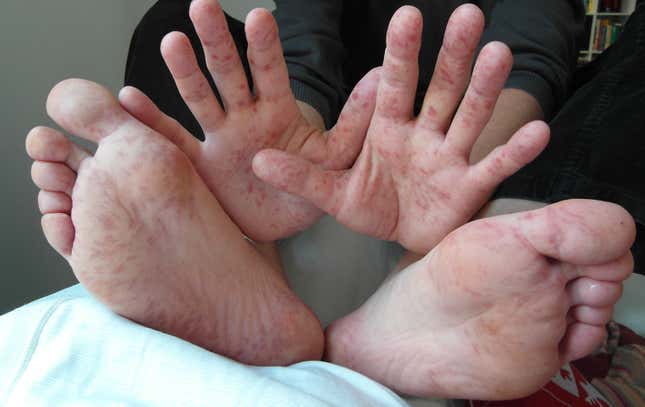 Hand, foot, and mouth disease in a 36-year-old male. 