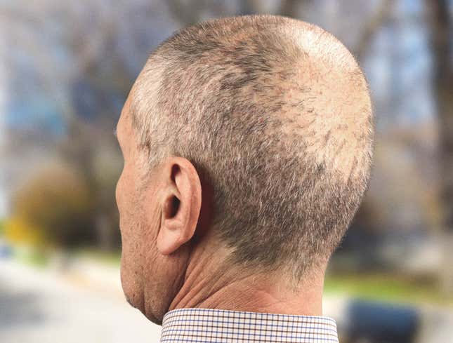 Image for article titled Bald Patch Must Be Spot Where Dog Keeps Pissing On Head