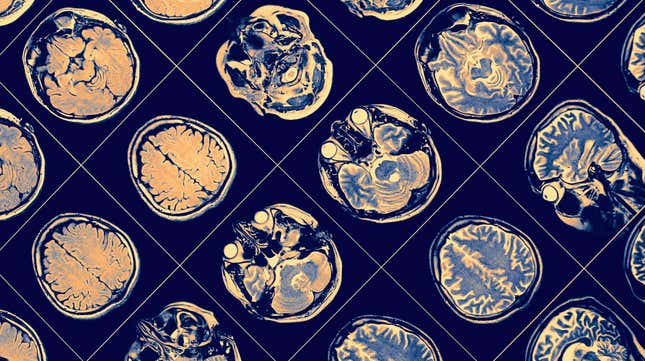 MRI brain images.
