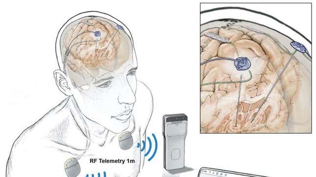 Una ilustración de la tecnología de estimulación cerebral profunda inalámbrica del equipo