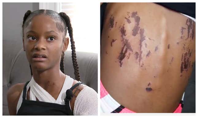 12-Year-Old Criminally Charged in Playground Acid Attack