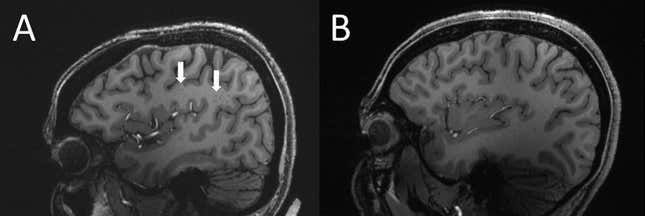 Una resonancia magnética de un cerebro con migraña y un cerebro sano