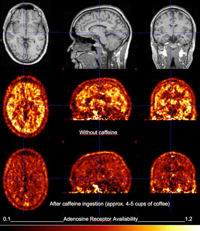 Caffeine blocks receptors in the brain that would normally attach to adenosine, an enzyme that makes you drowsy.
