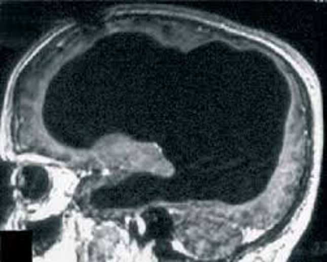Image for article titled A civil servant missing most of his brain challenges our most basic theories of consciousness