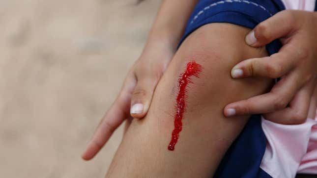 Child gets scraped knee that bleeds.