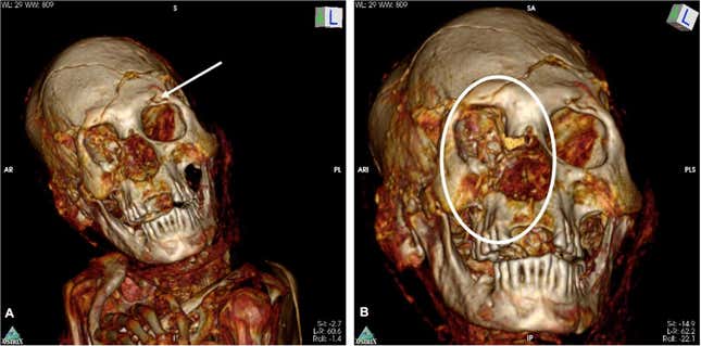 Two images showing areas where the deceased mummy was healed in life.