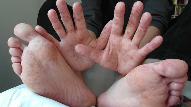 Hand, foot, and mouth disease in a 36-year-old man.