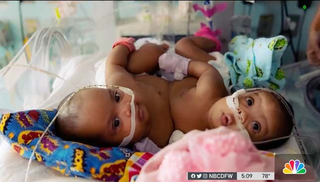 Image for article titled These Conjoined Twins Finally Went Home after an 11-Hour Surgery