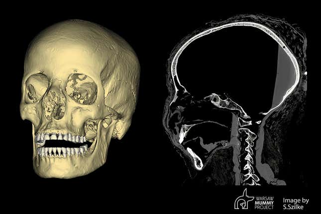 Imagen para el artículo titulado La primera momia egipcia embarazada conocida murió de cáncer