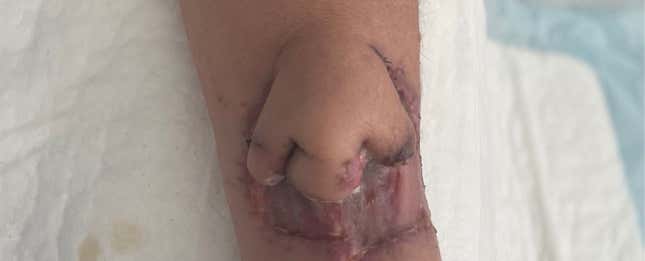 Por qué han puesto en un brazo una nariz impresa en 3D