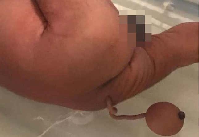 Imagen para el artículo titulado Nace un bebé con una cola humana de 12 centímetros