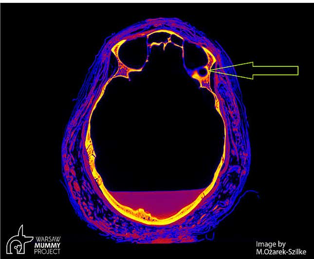 Imagen para el artículo titulado La primera momia egipcia embarazada conocida murió de cáncer