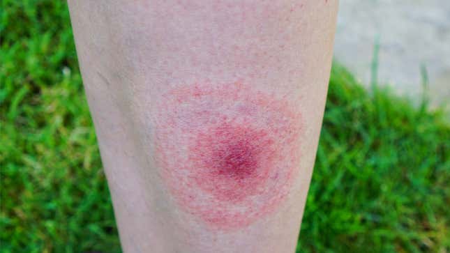 bulls eye rash on a person's leg