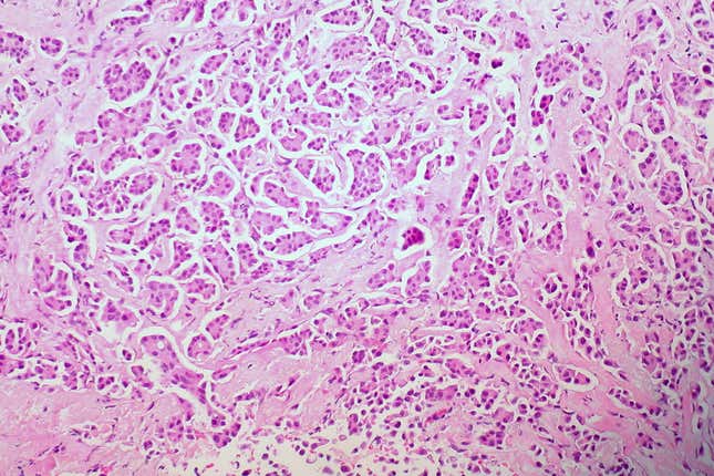 Imagen para el artículo titulado El cáncer de mama se propaga más rápido mientras duermes