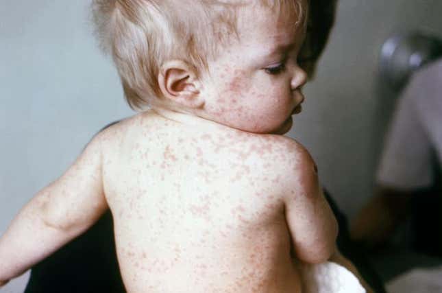 A young boy with measles