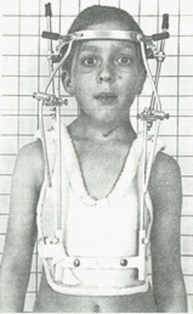 Munro with a metal halo brace after a series of spinal cord operations.