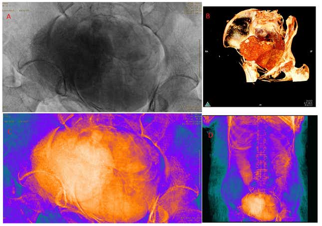 X-ray and CT scans of the mummy’s abdominal region, revealing the fetus.