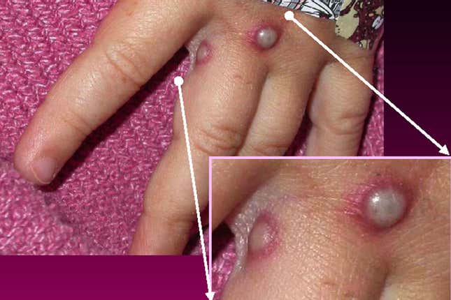 A patient with monkeypox lesions.