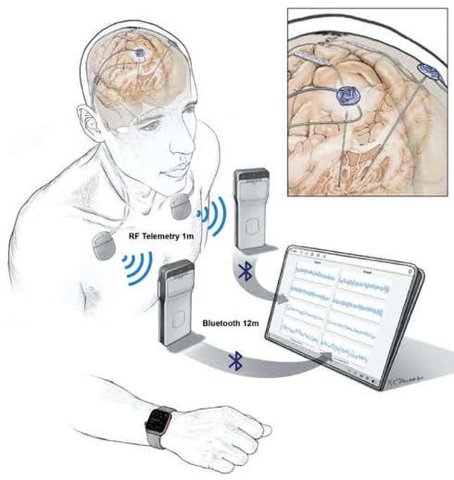 Los electrodos implantados transmiten los datos registrados a un dispositivo de bolsillo que lleva el paciente. Luego, los datos se transfieren de forma inalámbrica a una tableta y se cargan en la nube a través de un servidor compatible con HIPAA.
