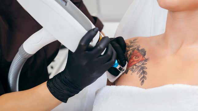 Image for article titled How Hard (and Painful) Is It to Get a Tattoo Removed?