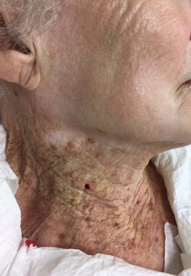 Imagen para el artículo titulado Este es el resultado de usar protector solar en la cara pero no en el cuello durante 40 años