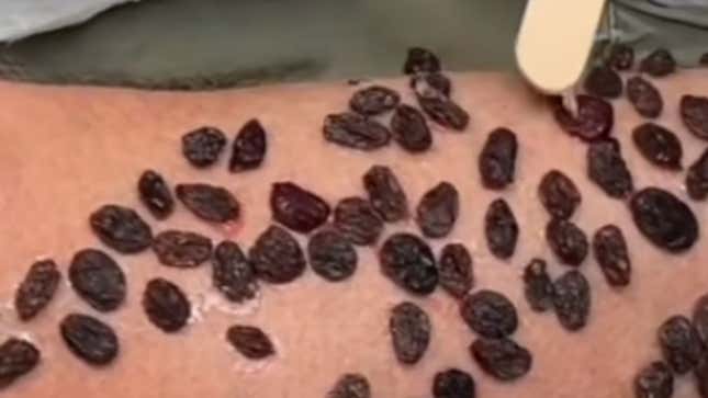 Raisins glued to a man's leg. You can see the glue.