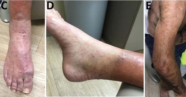 Some of the leprosy-caused lesions observed on the man’s limbs.