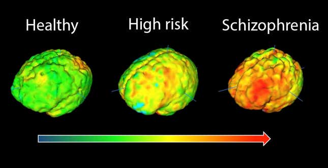 Image for article titled Instead of treating schizophrenia, scientists may have figured out a way to prevent it