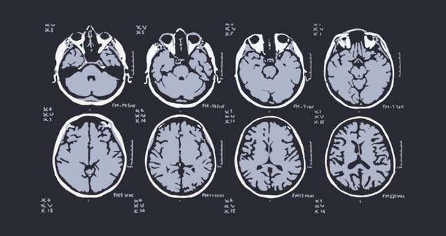 Image for article titled A tumor stole every memory I had. This is what happened when it all came back