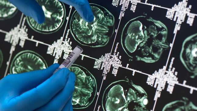 Imagen para el artículo titulado Una misteriosa enfermedad cerebral en Canadá podría estar afectando a decenas de personas