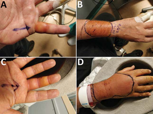 Die infizierten und geschwollenen Hände des Mannes, verursacht durch eine bisher unentdeckte Bakterienart.