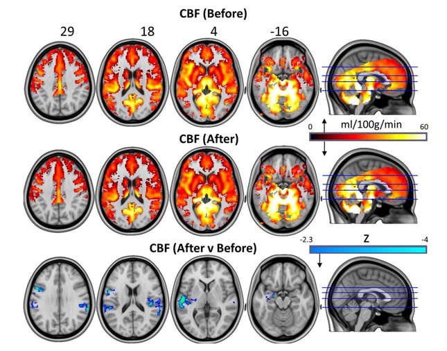 Whole-brain cerebral blood flow maps for baseline versus one-day post-treatment.