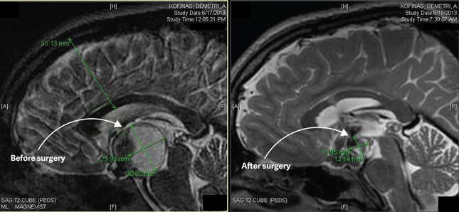 The tumor, full of fluid at left, empty at right. Radiation would be next.