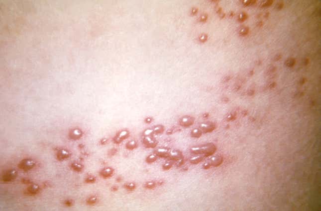 A close-up look at a shingle rash taken in 1966.