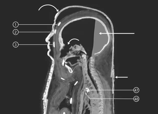 The mummy in profile reveals amulets on the mummy's surface, interior, and solidified resin in the back of the body's head.