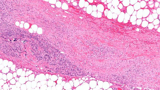 Image for article titled Flesh-Eating Bacteria Wishing It Hadn’t Filled Up On Foot