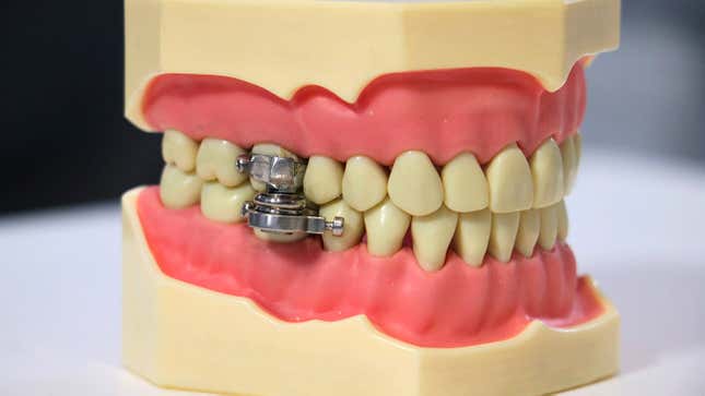 Image for article titled Terrifying Magnetic Mouth Clamp Pitched as a Rapid Weight Loss Tool [Updated]