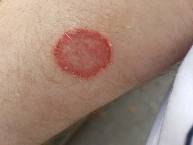 A case of ringworm found on someone’s forearm.