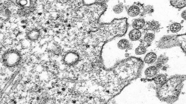 Viral particles of SARS-CoV-2, seen under a transmission electron microscope in a sample taken from a person.