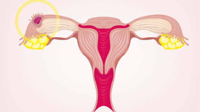 Image for article titled Why an Ectopic Pregnancy Can&#39;t Be &#39;Reimplanted&#39;