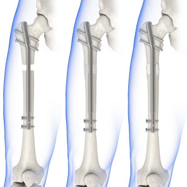 Leg lengthening procedure.
