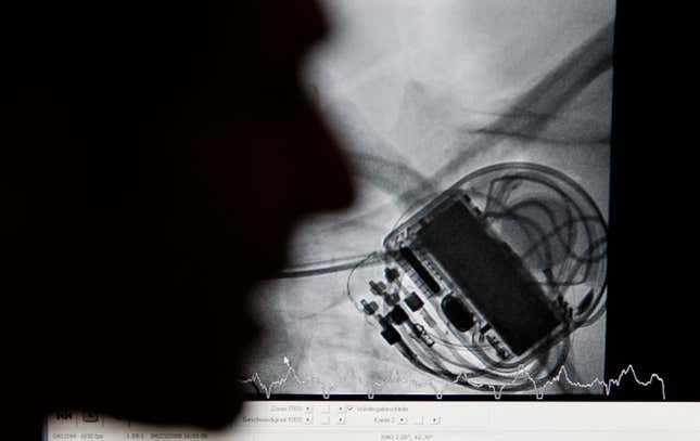 X-ray picture on a monitor showing of a cardiac re-synchronisation therapy defibrillator device