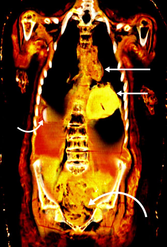 A CT scan of the mummy's abdominal cavity.